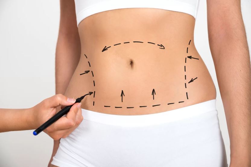 liposuction removes cellulite
