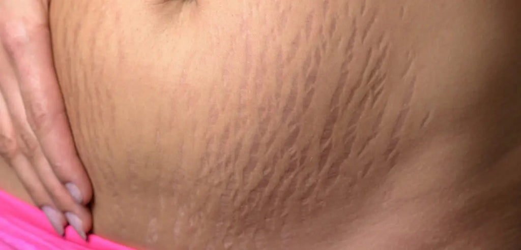 Best Stretch Mark Cream for Pregnancy