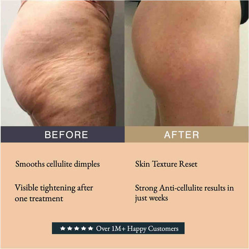 Before and after Guam Mud Seaweed wrap — reduced cellulite and firmer legs after 8 treatments