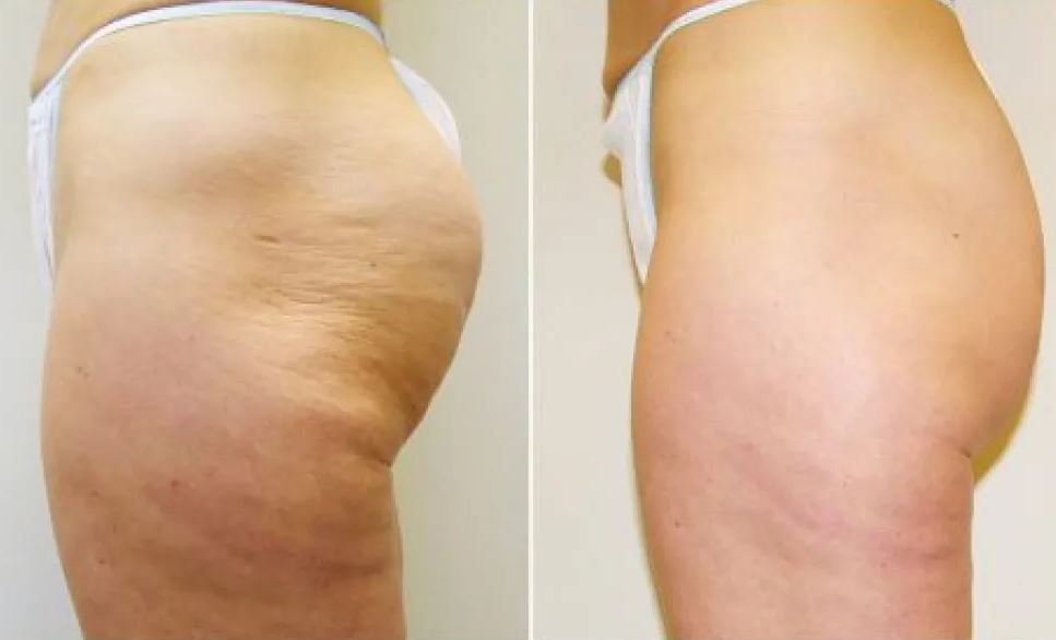 Cellulite: Scientific Proof That God Is a Man (Can New Cellulite Treatment  Help?)