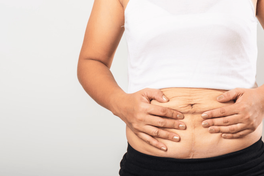 Woman holding loose, crepey stomach skin after pregnancy