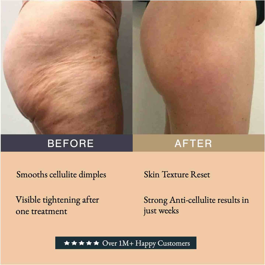 Infrared body wrap before and after: back of the thigh with cellulite before, and smoother after a course of GUAM infrared seaweed mud