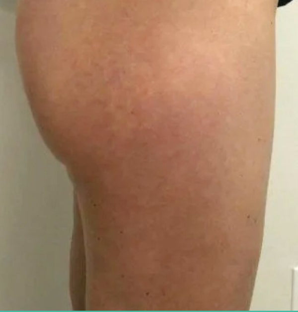 The same thigh looking smoother after a course of GUAM anti-cellulite wraps