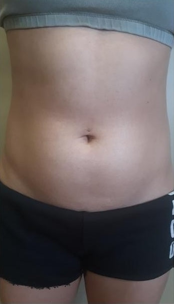 Stomach with loose skin and uneven texture before a course of GUAM Infrared Tummy Wraps