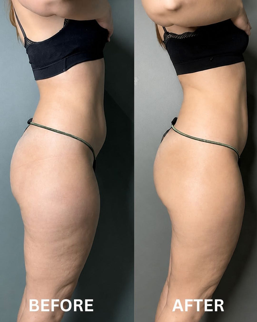 Side view of hips and thighs before and after, showing smoother skin, cellulite after weight loss